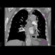 bronchial carcinoma, central, pneumonitis: CT - Computed tomography